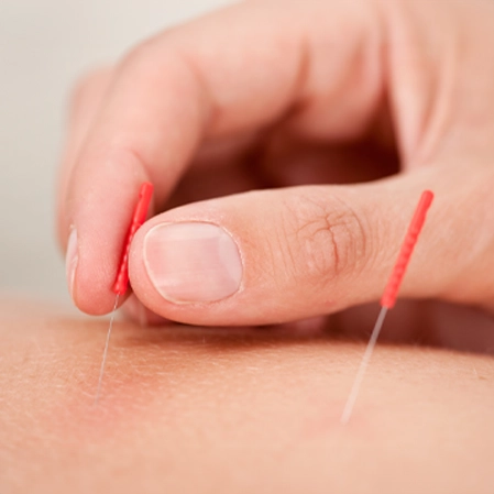 Chiropractic Columbia MD Dry Needling